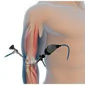 Elbow Arthroscopy