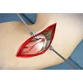 Open Elbow Surgery