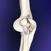 Elbow Ligament Reconstruction
