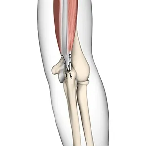 Triceps Tendon Repair