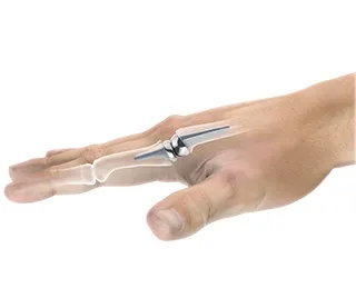 Artificial Finger Joint Replacement