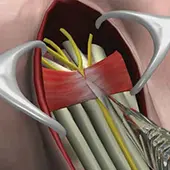 Carpal Tunnel Release Surgery