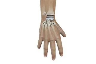 Wrist Joint Replacement