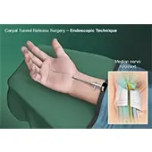 Endoscopic Carpal Tunnel Surgery