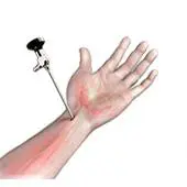 Wrist Arthroscopy