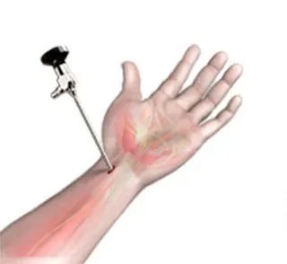 Wrist Arthroscopy