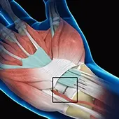 Wrist Ligament Reconstruction