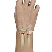 Wrist Fracture Surgery