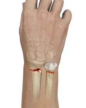 Wrist Fracture Surgery