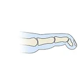Mallet Finger Splinting