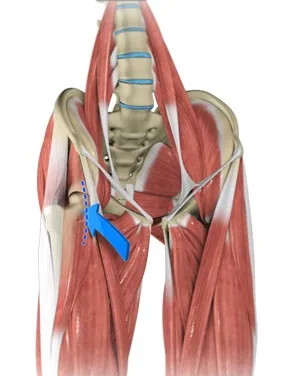 Anterior Hip Replacement