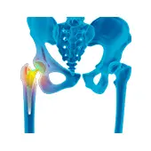 Revision Hip Replacement