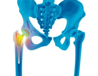 Revision Hip Replacement