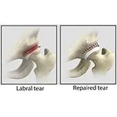 Hip Labral Repair
