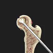 Hip Core Decompression