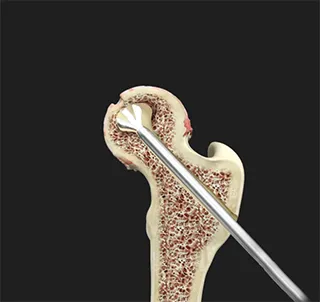 Hip Core Decompression