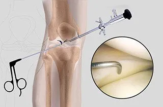 Knee Arthroscopy