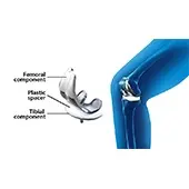 Total Knee Replacement