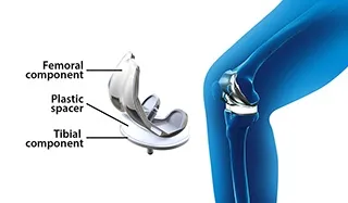 Total Knee Replacement