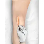 Minimally Invasive Knee Replacement