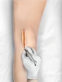 Minimally Invasive Knee Replacement
