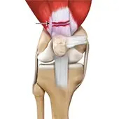 Quadriceps Tendon Rupture and Repair