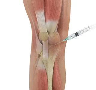 Knee Injections