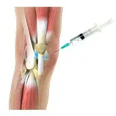 Viscosupplementation