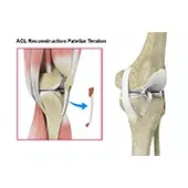 ACL Reconstruction