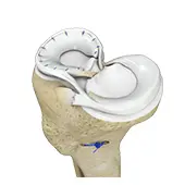 Meniscus Surgery