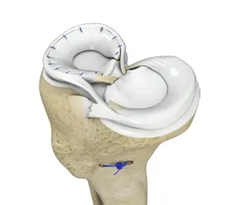 Meniscus Surgery