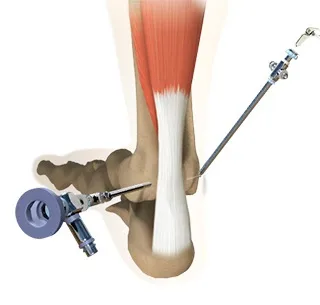 Ankle Arthroscopy