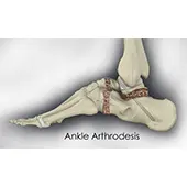 Ankle Arthrodesis