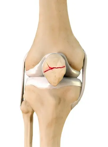 Patella Fracture