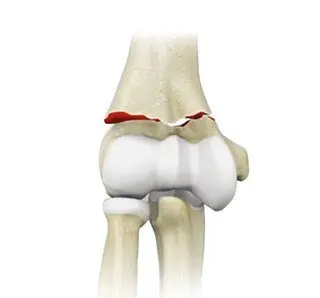 Elbow Fractures