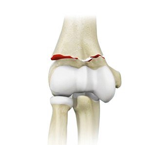 Elbow Fractures