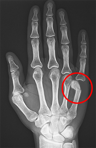 Boxer’s Fracture