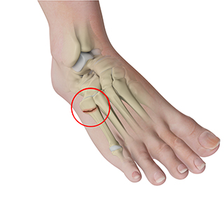 Jones Fracture Surgery
