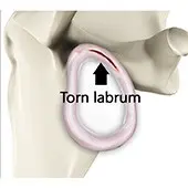 Shoulder Labral Tear
