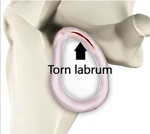Shoulder Labral Tear