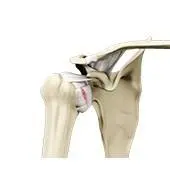 Shoulder Ligament Injuries