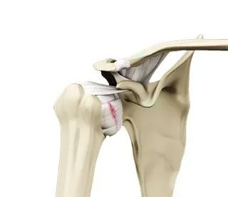 Shoulder Ligament Injuries