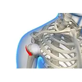 Shoulder Instability