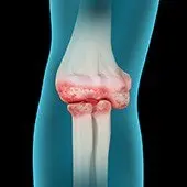 Elbow Arthritis