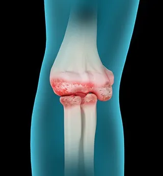 Elbow Arthritis