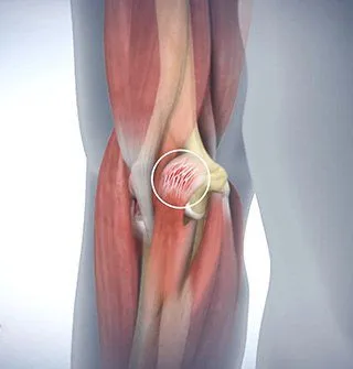 Golfer's Elbow