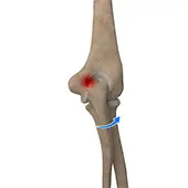 Elbow Impingement