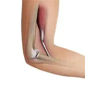 Distal Biceps Tendon Rupture