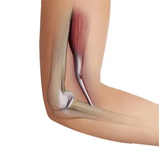 Distal Biceps Tendon Rupture