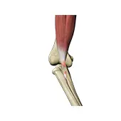 Biceps Tenodesis